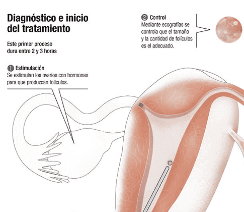 La Fecundación in Vitro con óvulos propios y semen de la pareja, paso a paso