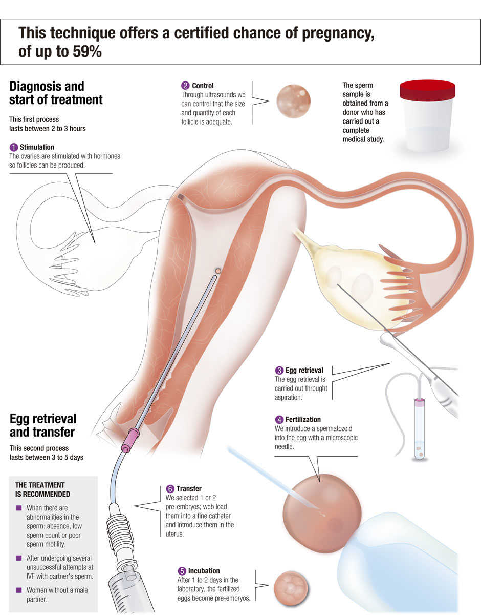 La Fecundación in Vitro con óvulos propios y semen de donante, paso a paso